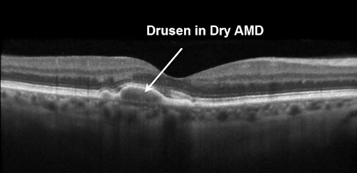 Drusen in Dry AMD